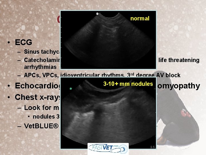 normal Cardiac Work-Up • ECG – Sinus tachycardia early on – Catecholamine induced cardiomyopathy