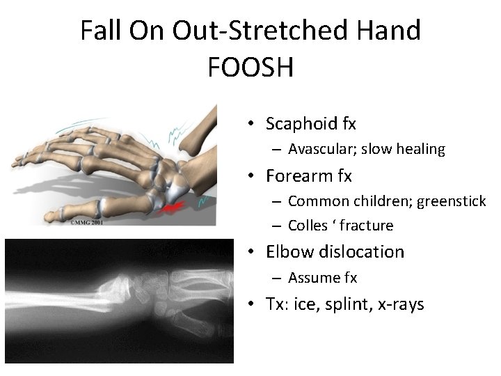Fall On Out-Stretched Hand FOOSH • Scaphoid fx – Avascular; slow healing • Forearm