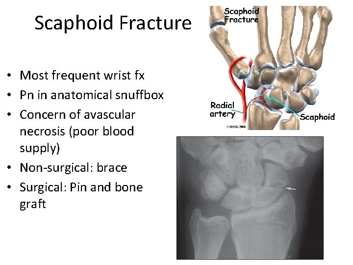 Scaphoid Fracture • Most frequent wrist fx • Pn in anatomical snuffbox • Concern