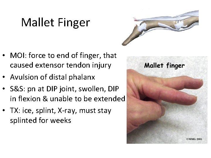 Mallet Finger • MOI: force to end of finger, that caused extensor tendon injury