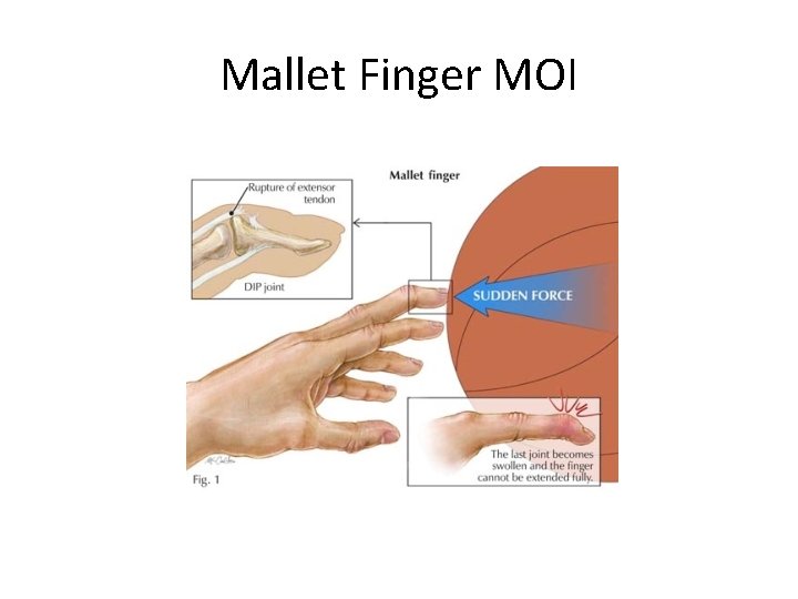 Mallet Finger MOI 