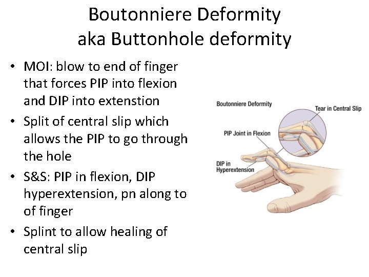 Boutonniere Deformity aka Buttonhole deformity • MOI: blow to end of finger that forces