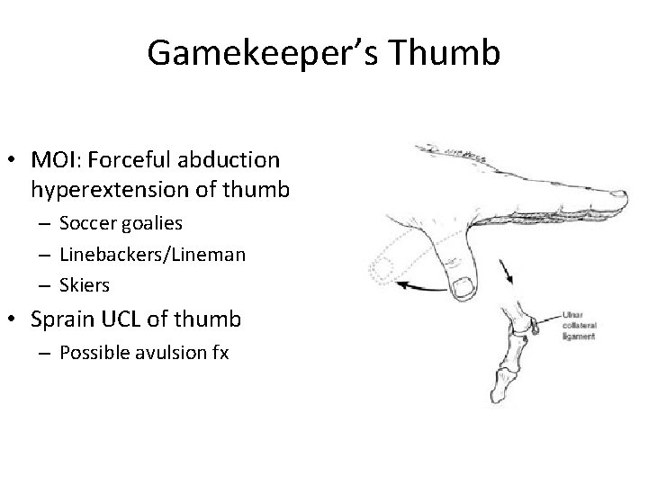 Gamekeeper’s Thumb • MOI: Forceful abduction hyperextension of thumb – Soccer goalies – Linebackers/Lineman