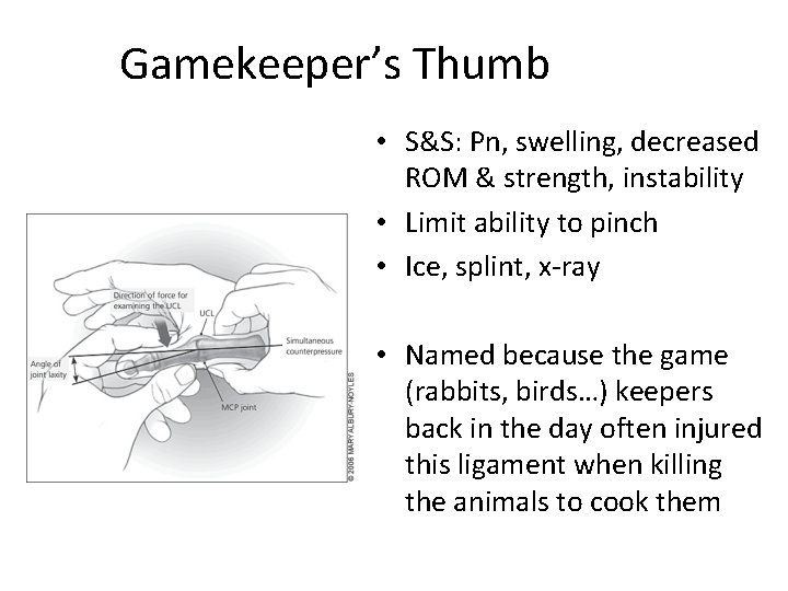 Gamekeeper’s Thumb • S&S: Pn, swelling, decreased ROM & strength, instability • Limit ability