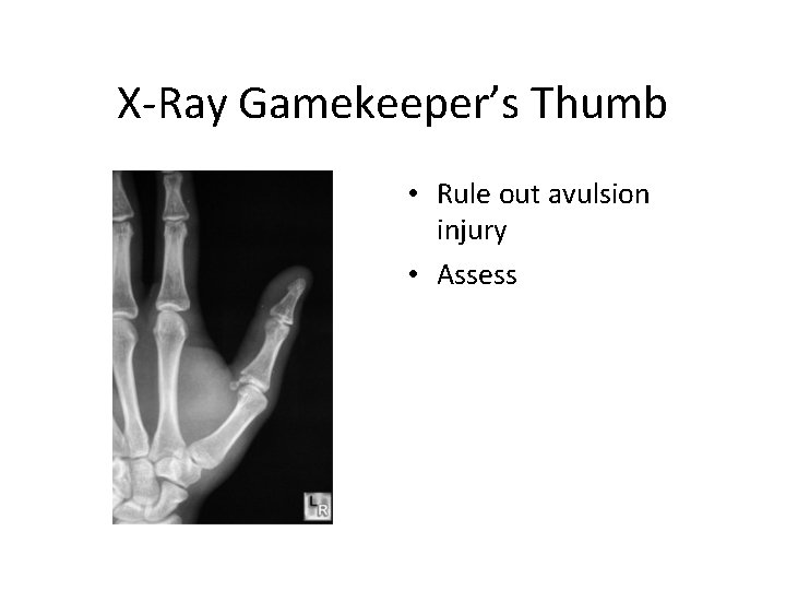X-Ray Gamekeeper’s Thumb • Rule out avulsion injury • Assess 