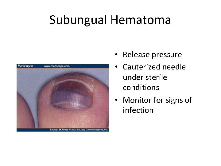 Subungual Hematoma • Release pressure • Cauterized needle under sterile conditions • Monitor for
