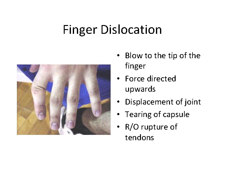 Finger Dislocation • Blow to the tip of the finger • Force directed upwards
