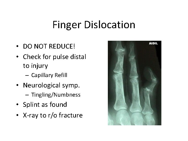Finger Dislocation • DO NOT REDUCE! • Check for pulse distal to injury –