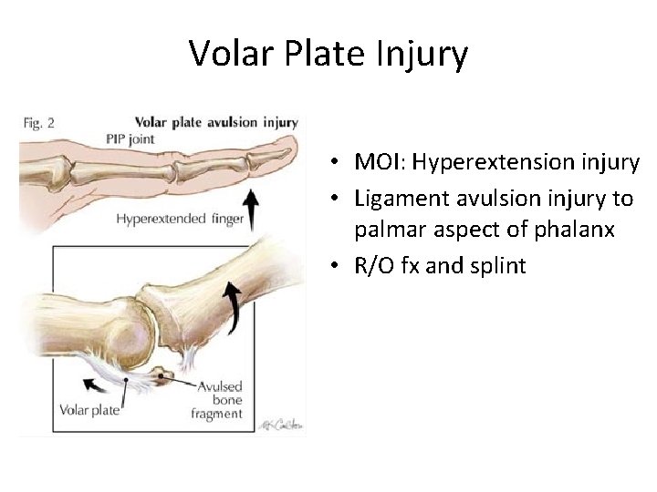 Volar Plate Injury • MOI: Hyperextension injury • Ligament avulsion injury to palmar aspect