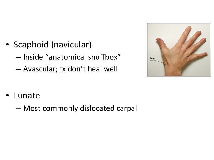  • Scaphoid (navicular) – Inside “anatomical snuffbox” – Avascular; fx don’t heal well