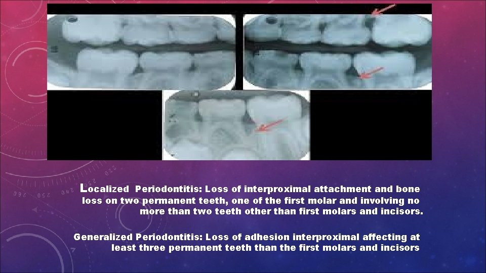 Localized Periodontitis: Loss of interproximal attachment and bone loss on two permanent teeth, one