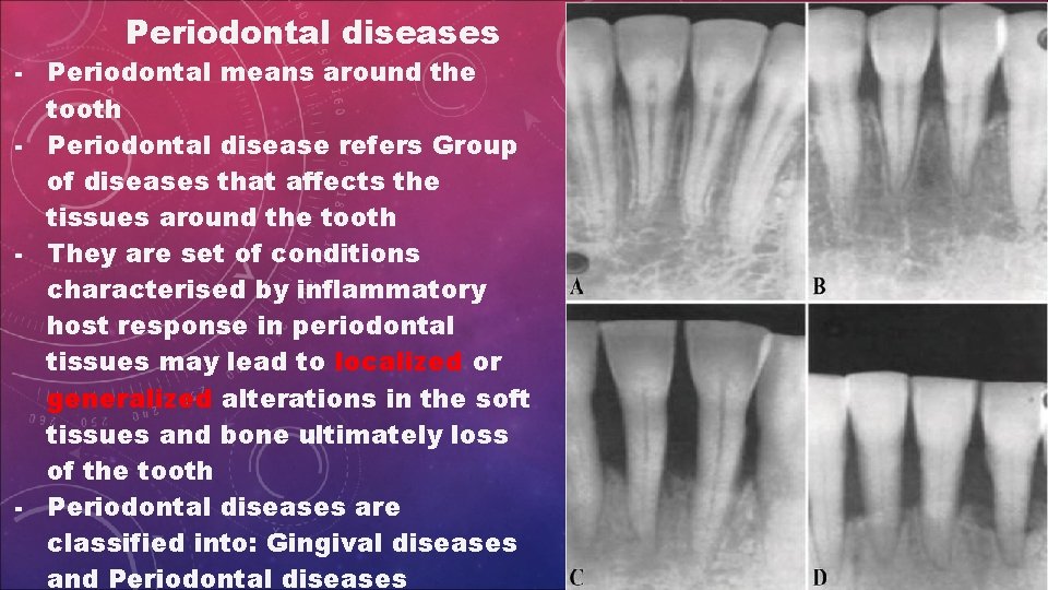 Periodontal diseases - Periodontal means around the tooth - Periodontal disease refers Group of