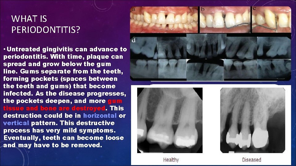 WHAT IS PERIODONTITIS? • Untreated gingivitis can advance to periodontitis. With time, plaque can