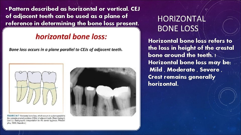  • Pattern described as horizontal or vertical. CEJ of adjacent teeth can be