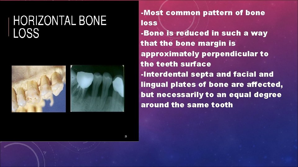 -Most common pattern of bone loss -Bone is reduced in such a way that