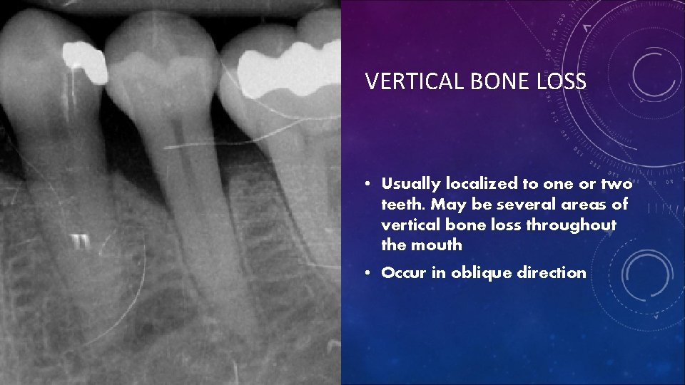 VERTICAL BONE LOSS • Usually localized to one or two teeth. May be several