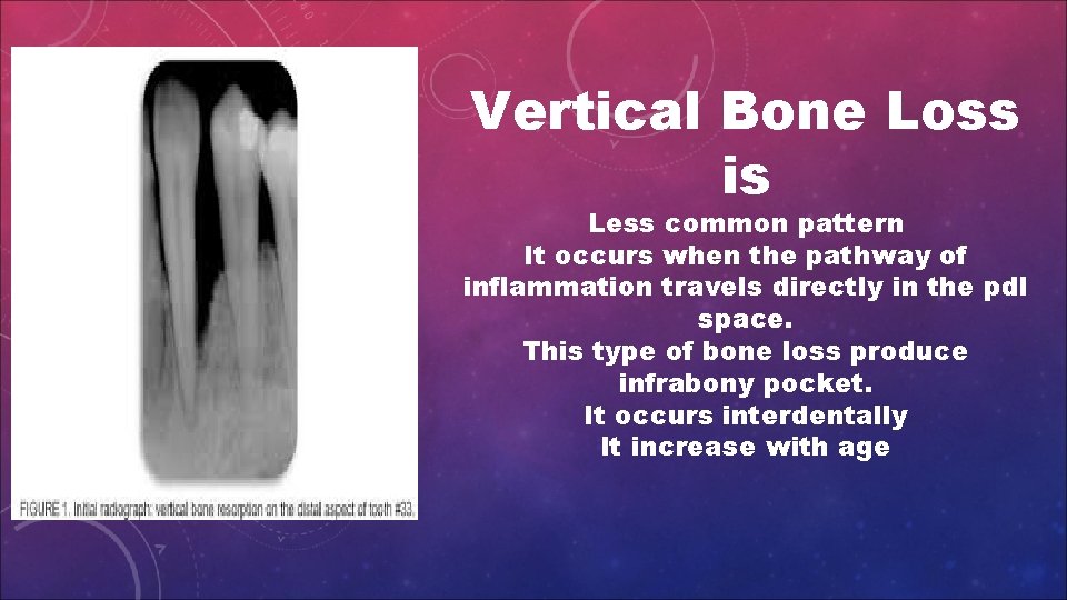 Vertical Bone Loss is Less common pattern It occurs when the pathway of inflammation