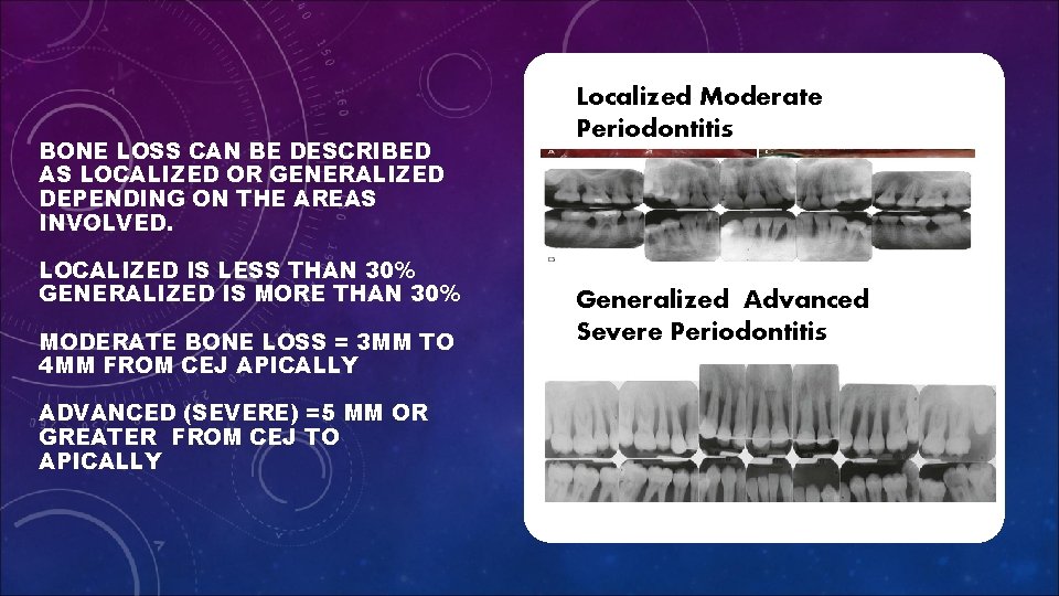 BONE LOSS CAN BE DESCRIBED AS LOCALIZED OR GENERALIZED DEPENDING ON THE AREAS INVOLVED.