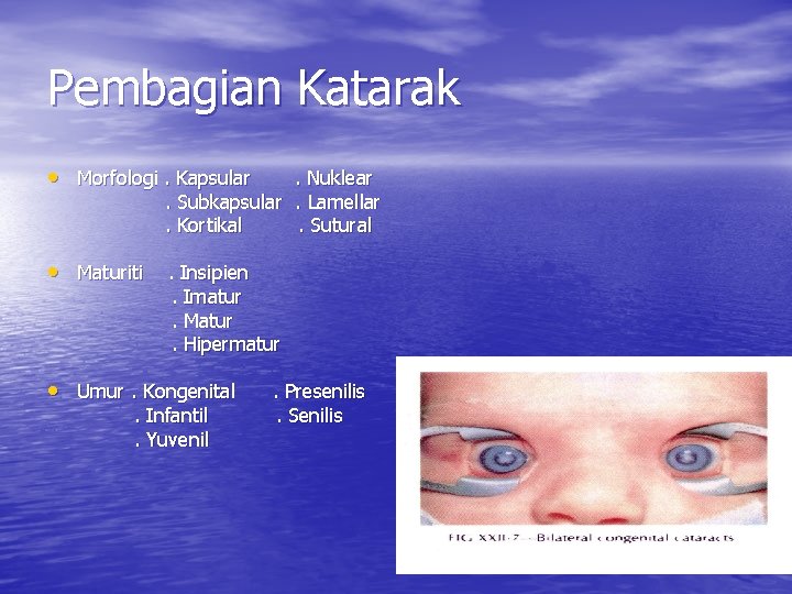 Pembagian Katarak • Morfologi. Kapsular . Nuklear. Subkapsular. Lamellar. Kortikal. Sutural • Maturiti. Insipien