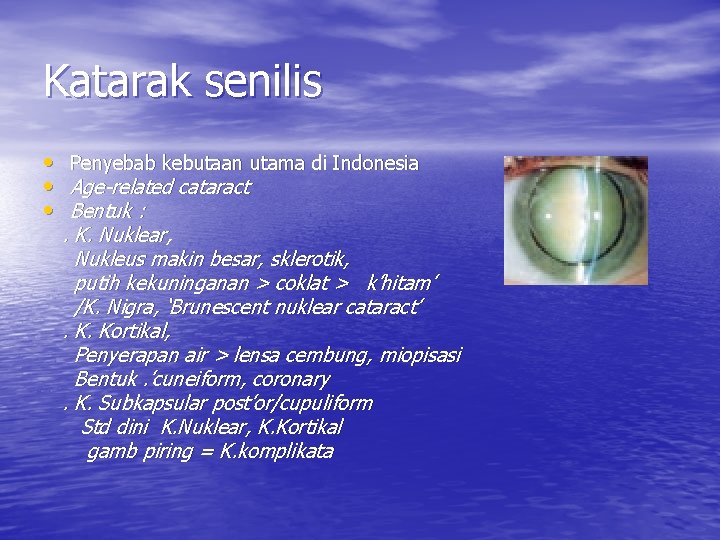 Katarak senilis • Penyebab kebutaan utama di Indonesia • Age-related cataract • Bentuk :