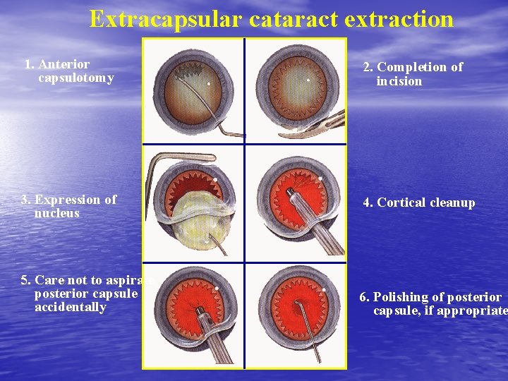Extracapsular cataract extraction 1. Anterior capsulotomy 2. Completion of incision 3. Expression of nucleus