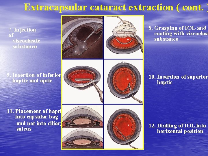 Extracapsular cataract extraction ( cont. ) 7. Injection of viscoelastic substance 8. Grasping of