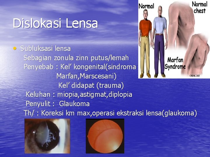 Dislokasi Lensa • Subluksasi lensa Sebagian zonula zinn putus/lemah Penyebab : Kel’ kongenital(sindroma Marfan,