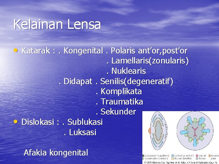 Kelainan Lensa • Katarak : . Kongenital. Polaris ant’or, post’or • . Lamellaris(zonularis). Nuklearis.