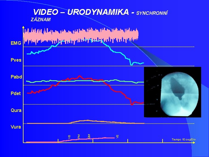 VIDEO – URODYNAMIKA - SYNCHRONNÍ ZÁZNAM EMG Pves Pabd Pdet Qura VE QM PM VIDEO – URODYNAMIKA - SYNCHRONNÍ ZÁZNAM EMG Pves Pabd Pdet Qura VE QM PM