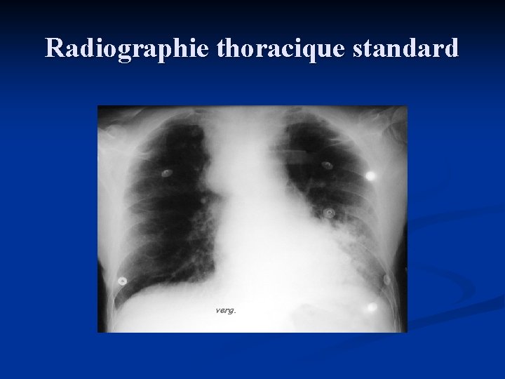 Radiographie thoracique standard 