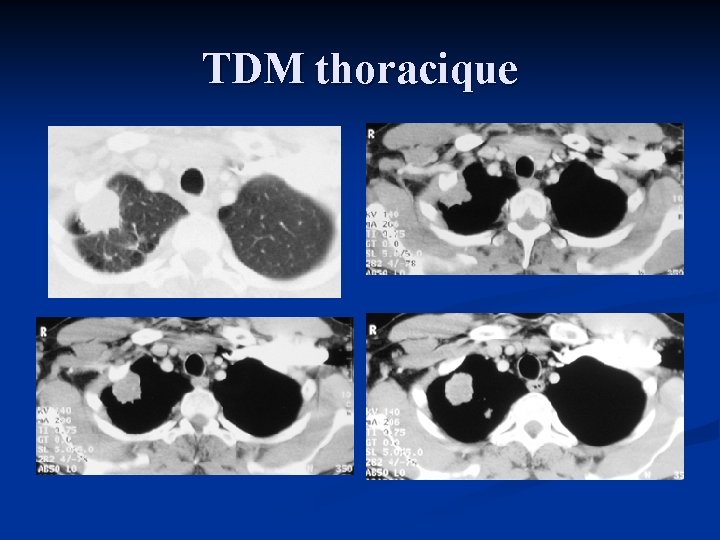 TDM thoracique 