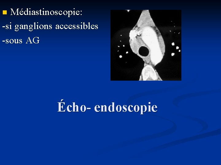 Médiastinoscopie: -si ganglions accessibles -sous AG n Écho- endoscopie 