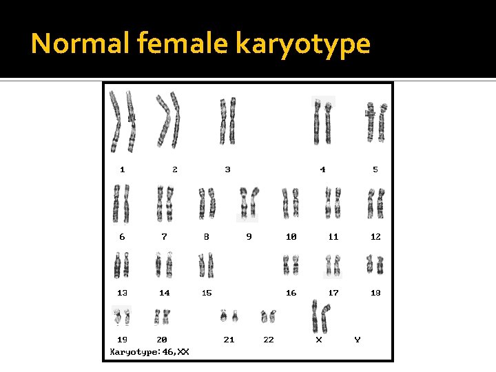 Normal female karyotype 