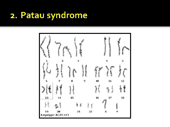 2. Patau syndrome 