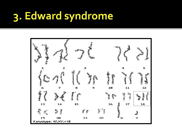 3. Edward syndrome 