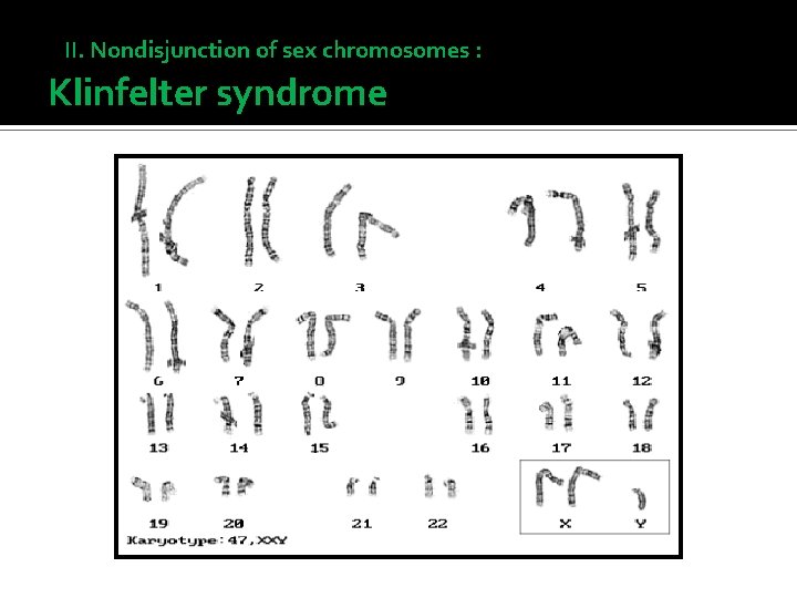 II. Nondisjunction of sex chromosomes : Klinfelter syndrome 