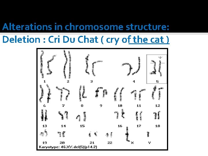 Alterations in chromosome structure: Deletion : Cri Du Chat ( cry of the cat