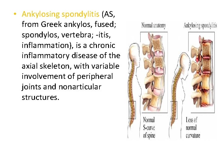  • Ankylosing spondylitis (AS, from Greek ankylos, fused; spondylos, vertebra; -itis, inflammation), is