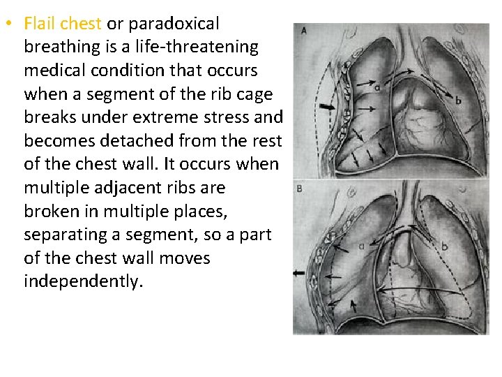  • Flail chest or paradoxical breathing is a life-threatening medical condition that occurs