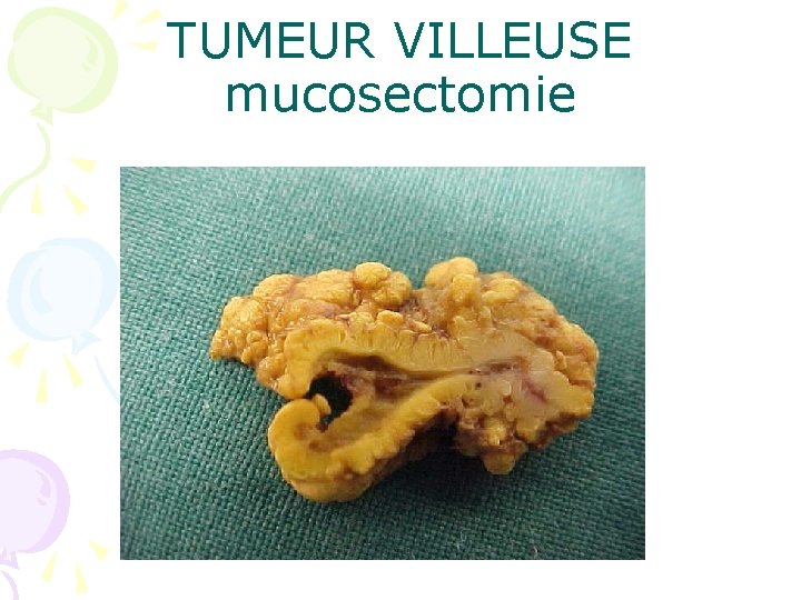 TUMEUR VILLEUSE mucosectomie 