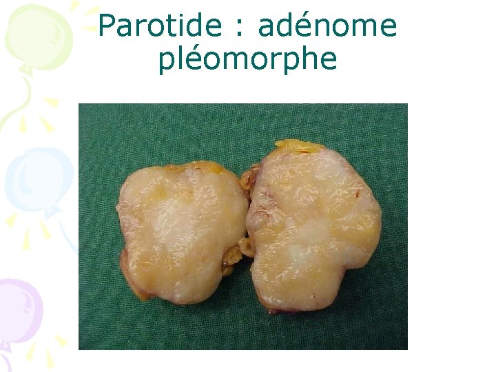 Parotide : adénome pléomorphe 