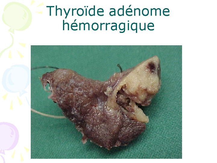 Thyroïde adénome hémorragique 