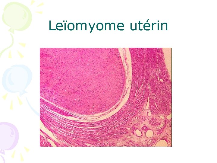 Leïomyome utérin 