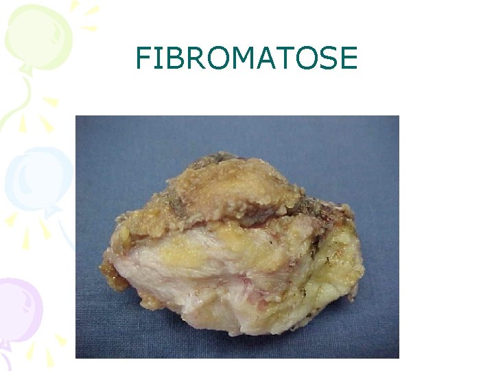 FIBROMATOSE 