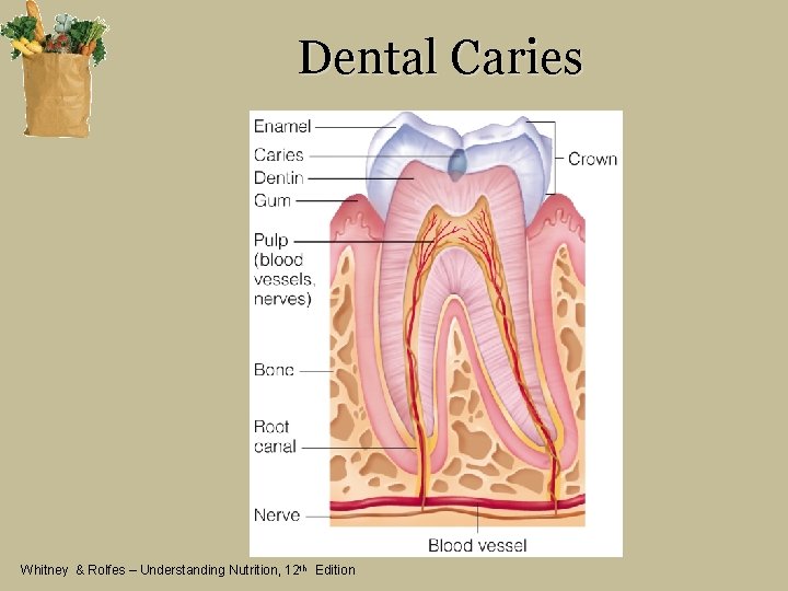 Dental Caries Whitney & Rolfes – Understanding Nutrition, 12 th Edition 