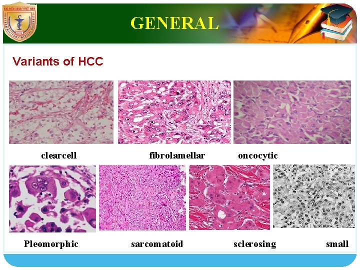 LOGO GENERAL Variants of HCC clearcell Pleomorphic fibrolamellar sarcomatoid oncocytic sclerosing small 