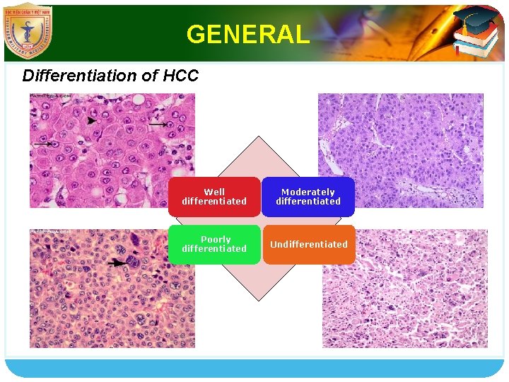 GENERAL Differentiation of HCC Well differentiated Moderately differentiated Poorly differentiated Undifferentiated LOGO 