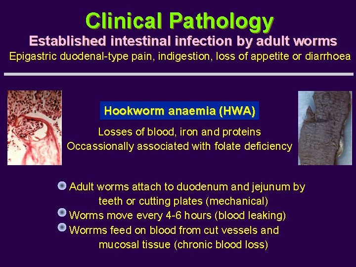 Clinical Pathology Established intestinal infection by adult worms Epigastric duodenal-type pain, indigestion, loss of
