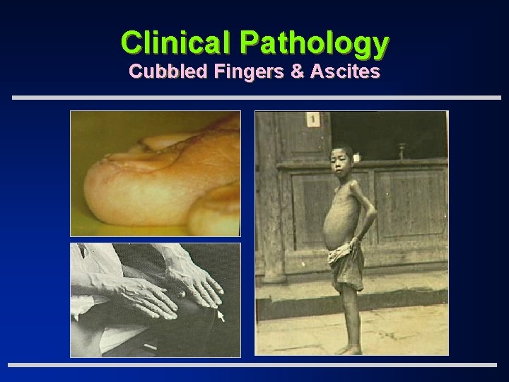Clinical Pathology Cubbled Fingers & Ascites 