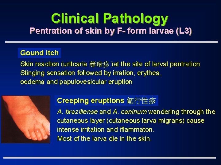 Clinical Pathology Pentration of skin by F- form larvae (L 3) Gound itch Skin